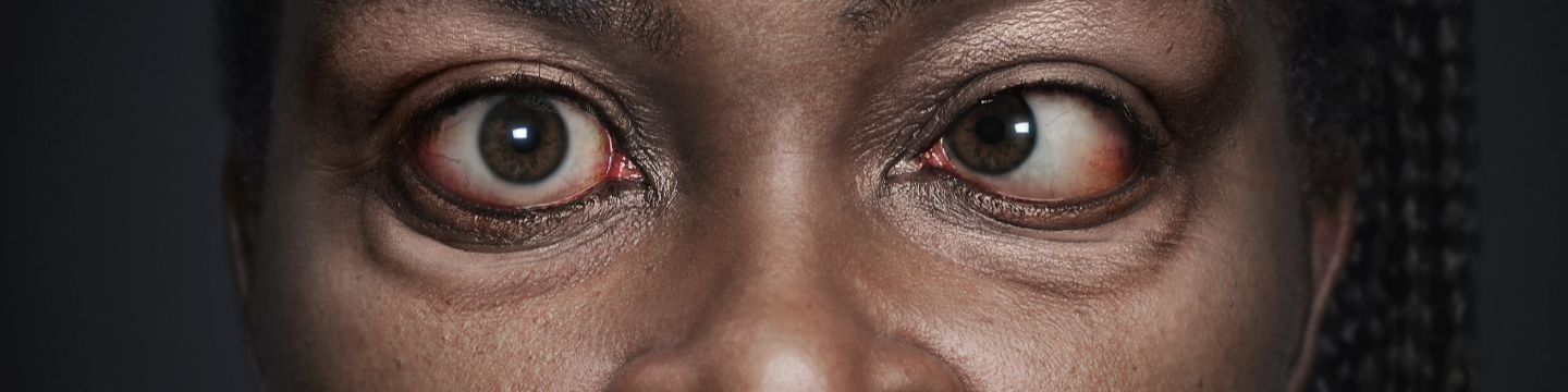 misaligned eyes thyroid eye disease