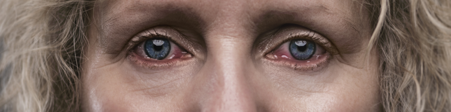 red eyes thyroid eye disease