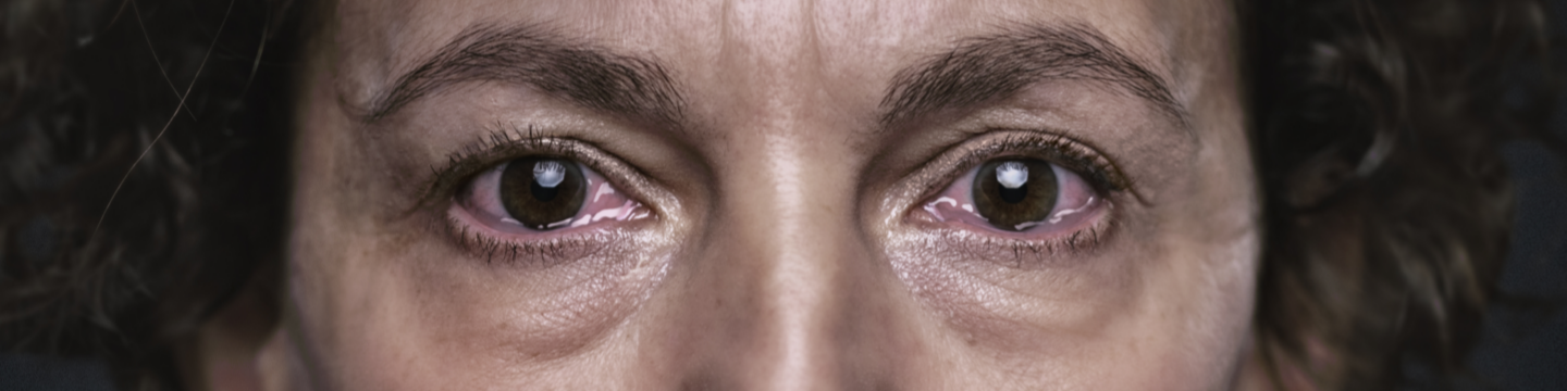 red teary eyes thyroid eye disease