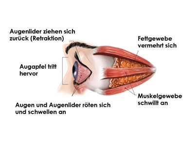 Eye during "acute" Thyroid Eye Disease phase