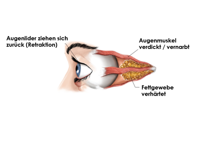 Eye during "chronic" Thyroid Eye Disease phase
